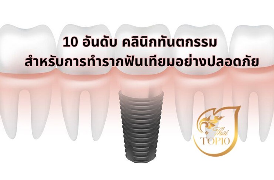 10 อันดับ คลินิกทันตกรรม สำหรับการทำรากฟันเทียมอย่างปลอดภัย